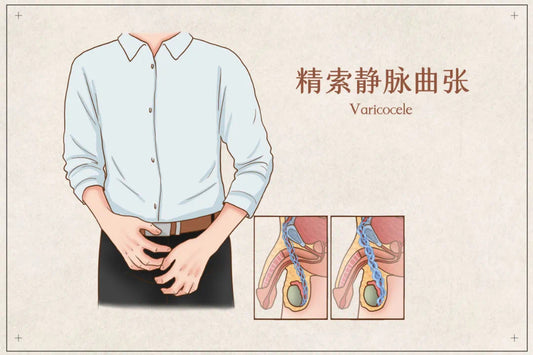 精索靜脈曲張是怎麼回事?該如何治療?