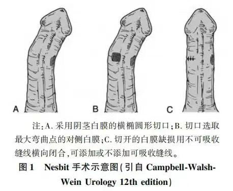 陰莖硬結症手術專家共識