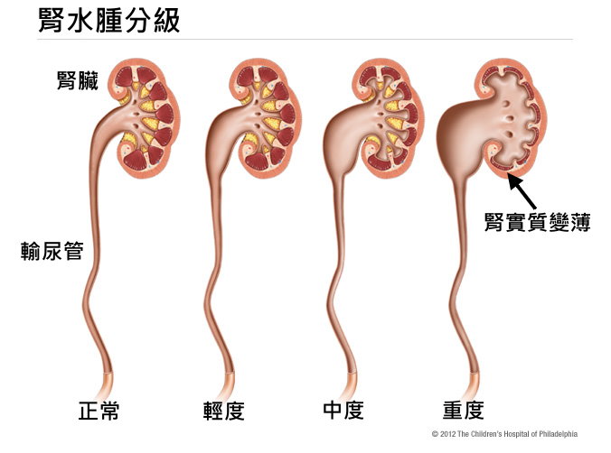 發現腎積水不治療，會怎樣？